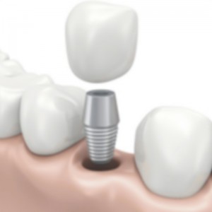 Dentalimplantat